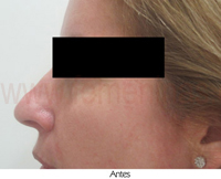 Imperfecciones de nariz sin pasar por el quirófano