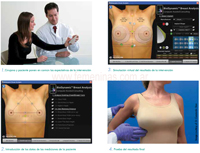 Simulador Virtual para la Mamoplastia